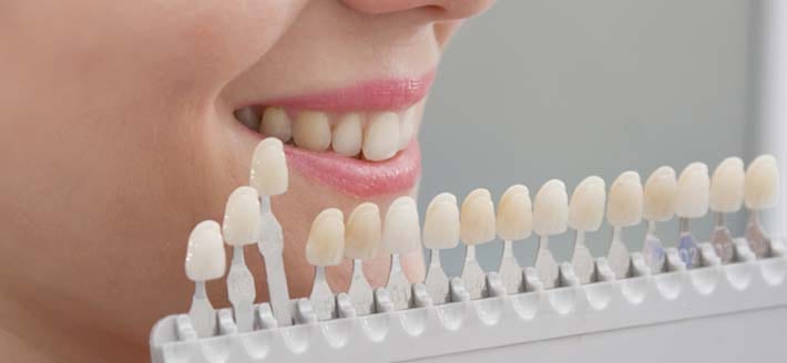 Guía de tonos dentales junto a la sonrisa de una paciente para elegir el color de la resina