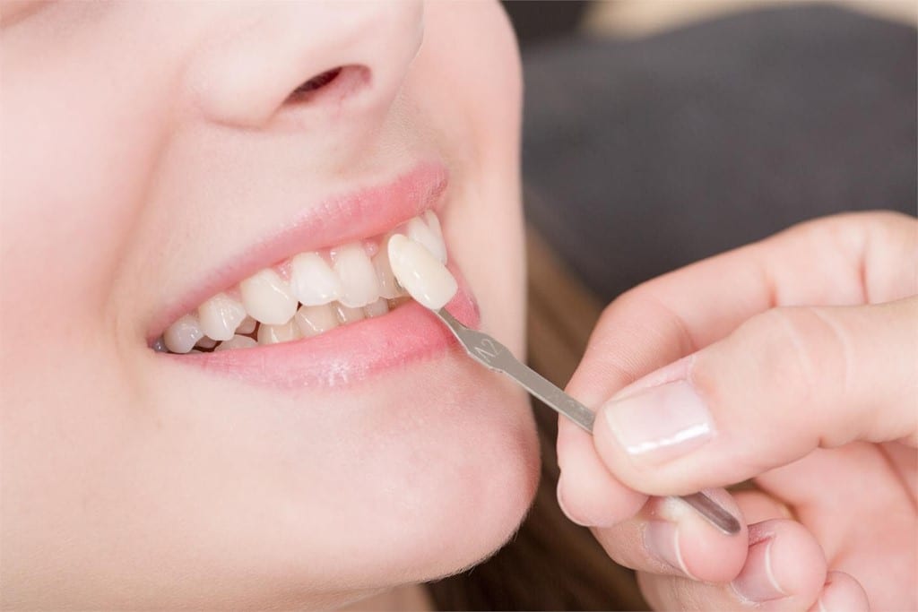 Comparación del tono de una restauración dental frente a los dientes de la paciente